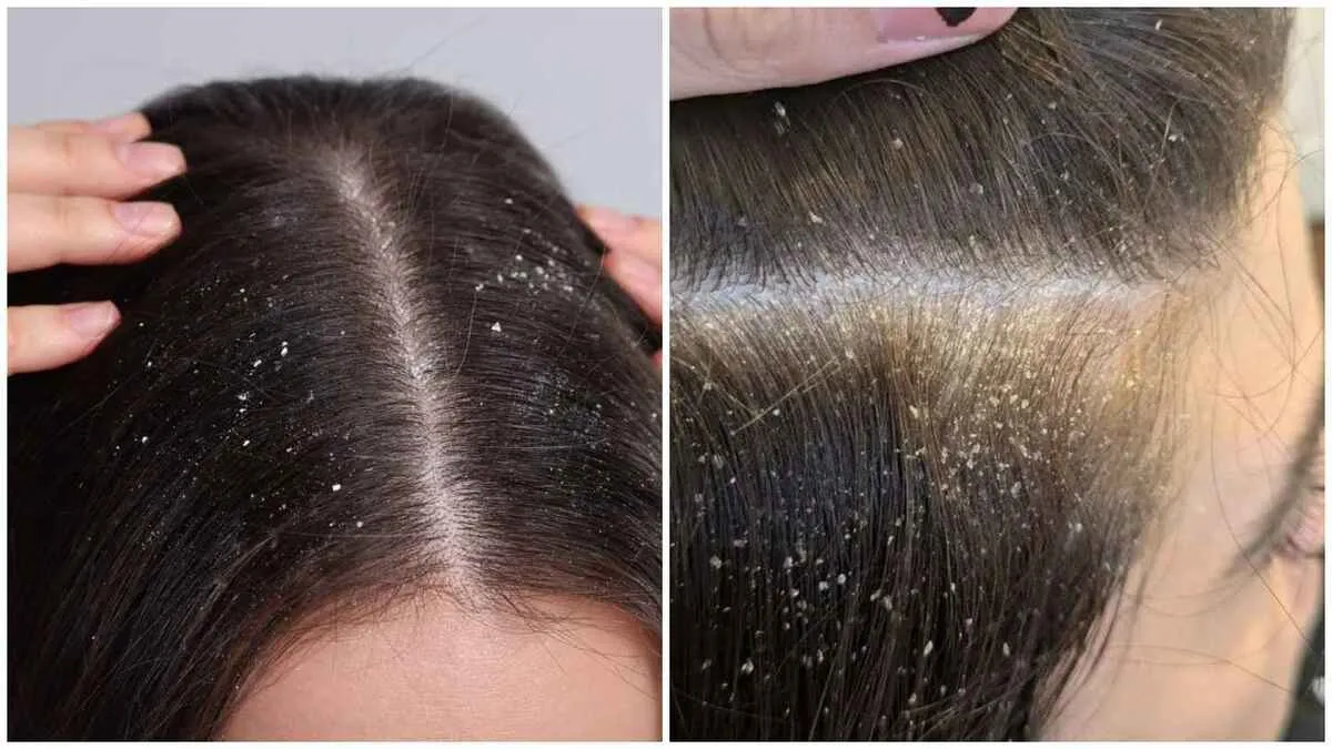 Scalp Buildup Vs Dandruff