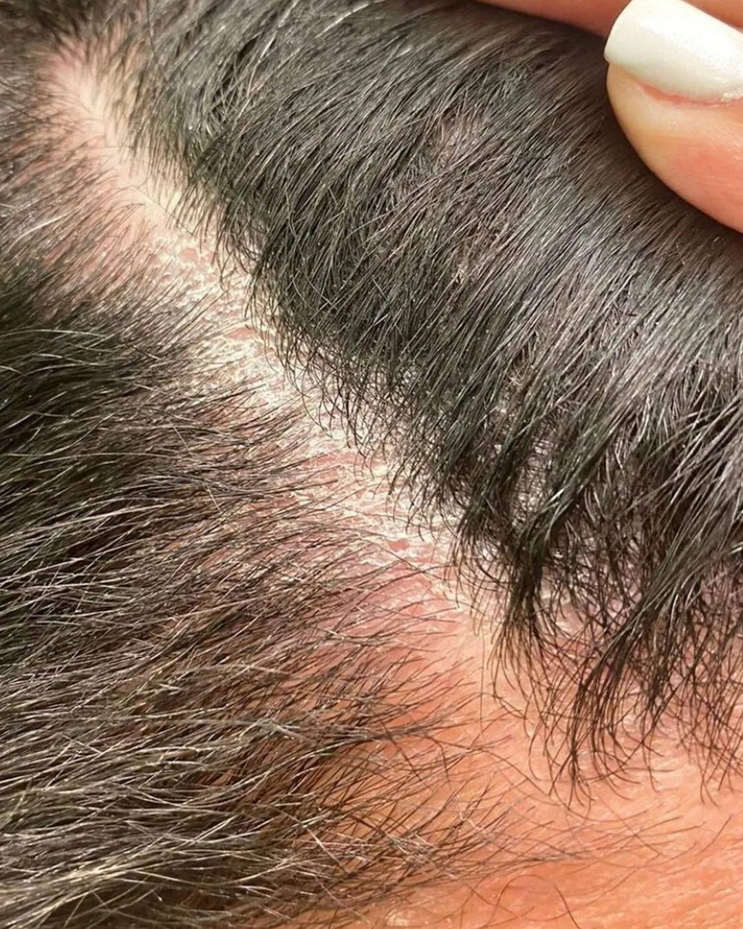 scalp builup 2
