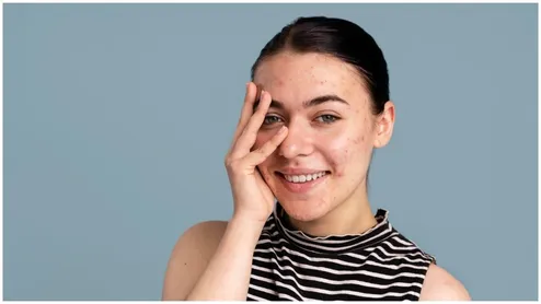 Acne Scars And Treatment