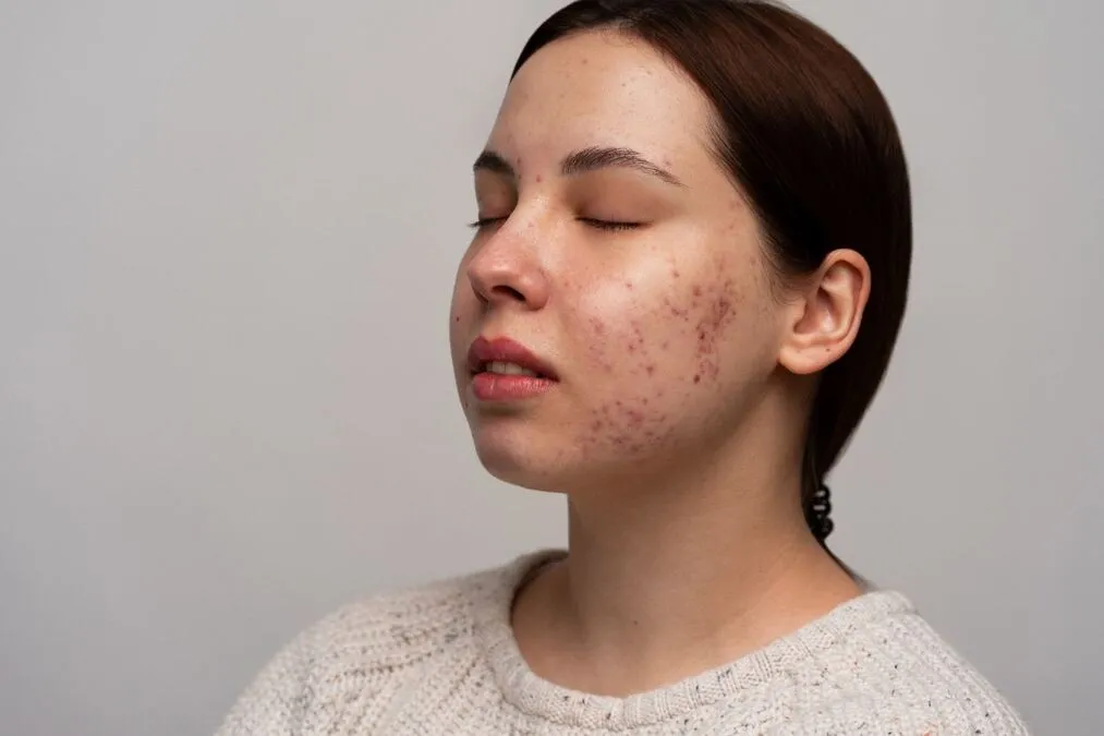 acne scars