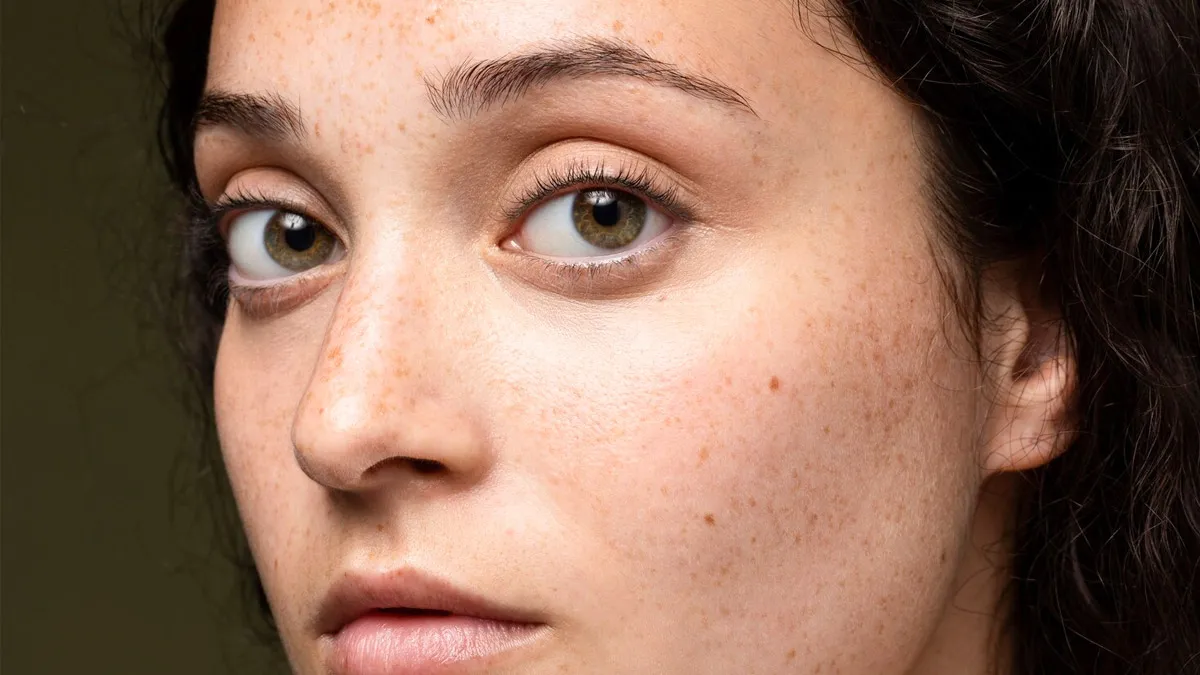 Why Pigmentation Keeps Coming Back