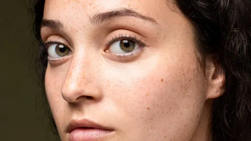 Why Pigmentation Keeps Coming Back