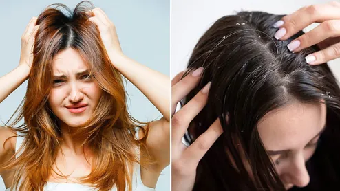 Dry Scalp Vs Dandruff In Winters