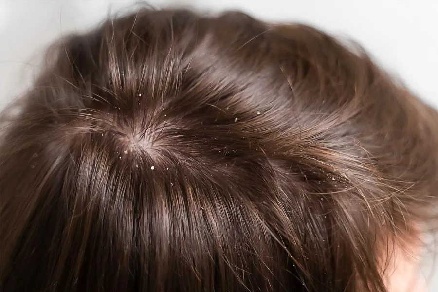 dandruff