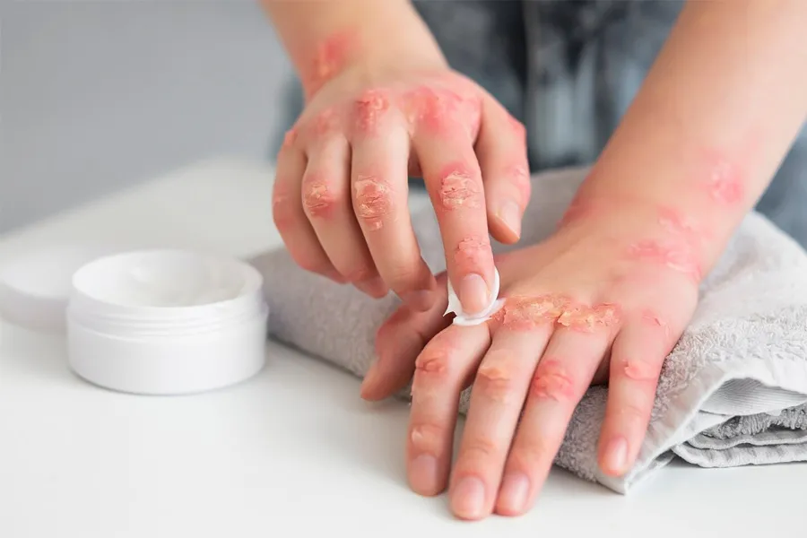 Treatment Psoriasis