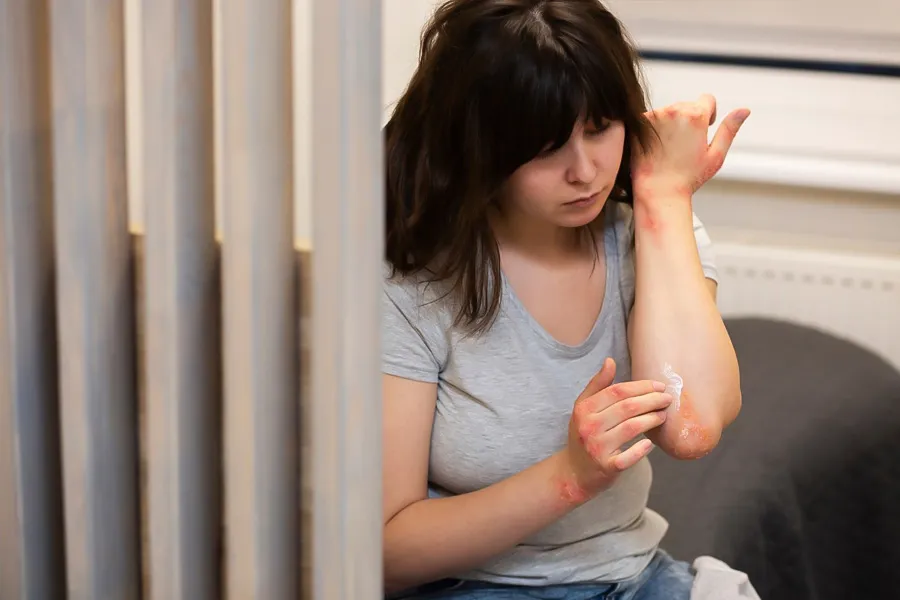 is psoriasis contagious