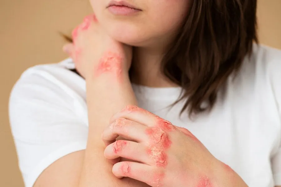 myths around psoriasis