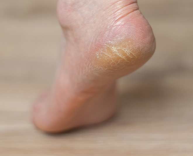 remedy-for-rough-cracked-heels