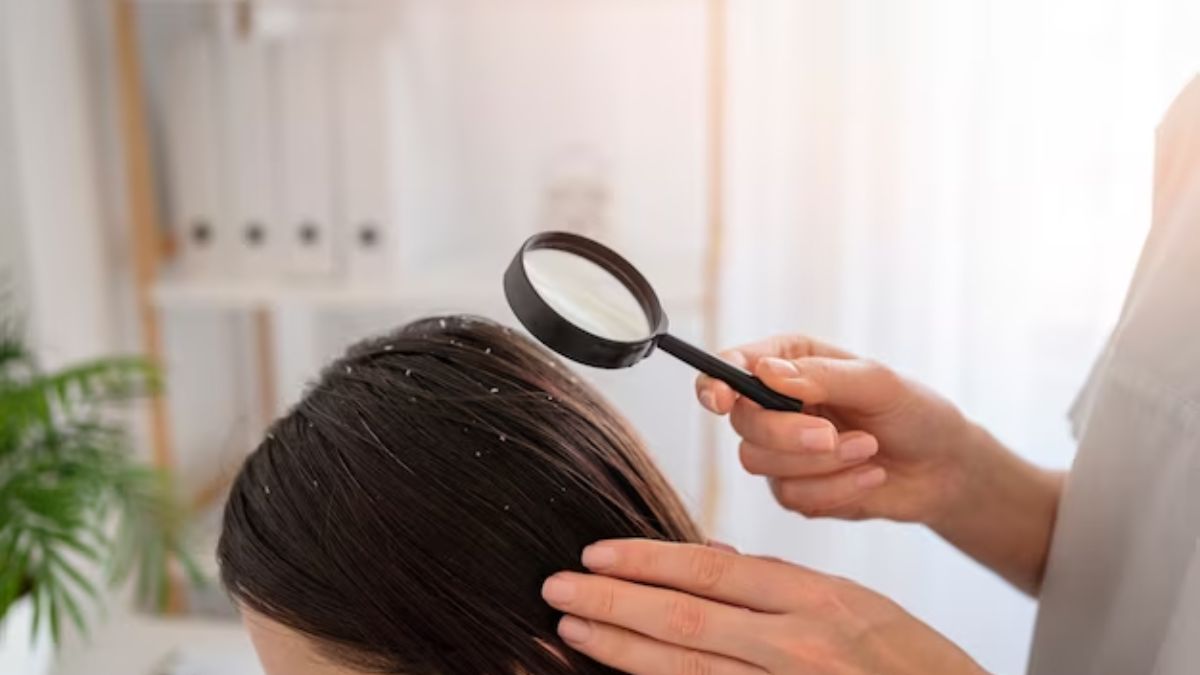home remedies to remove hair dandruff