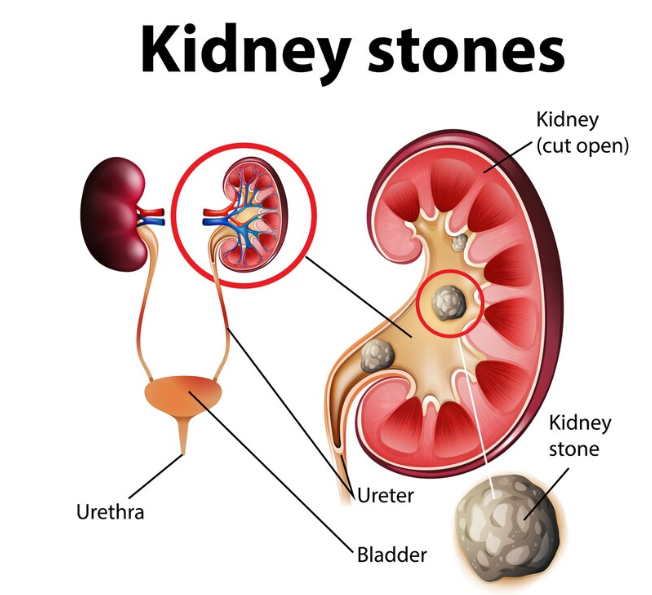 kidney stone