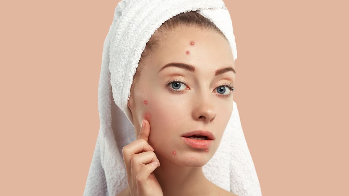 Face Care Tips | Dark Spots | चेहरे की देखभाल कैसे करें | pimples dark  spots removal easy face care tips | HerZindagi