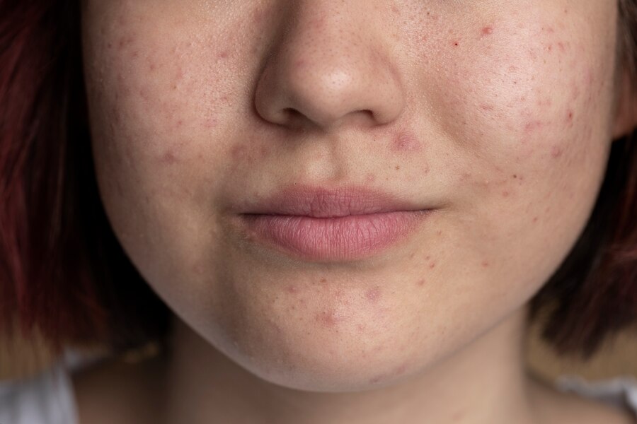 acne scars
