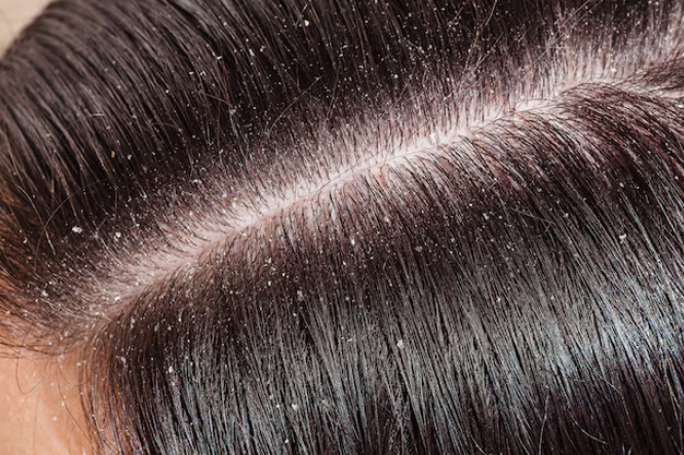 what is dandruff