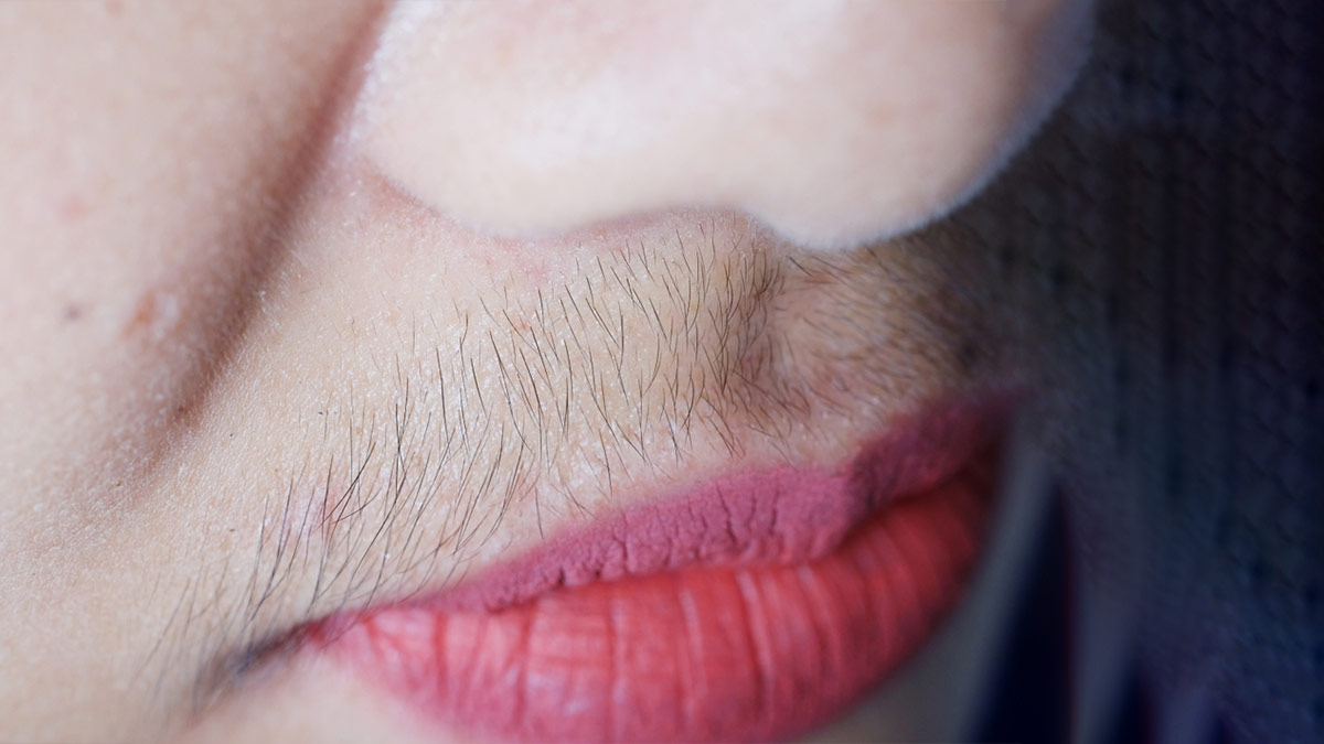facial hair in pcos