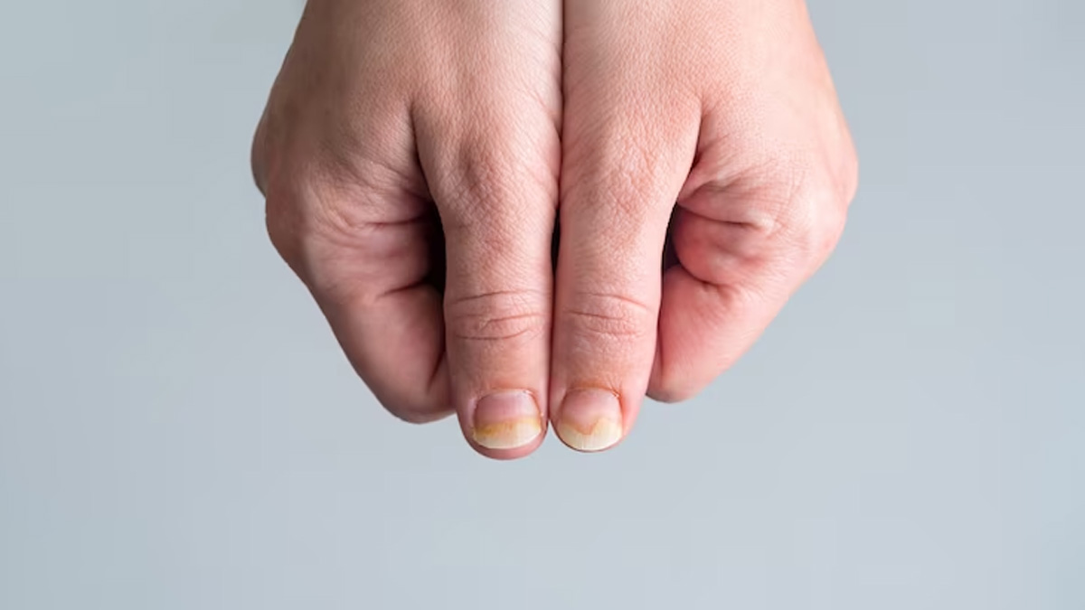 yellow nail causes