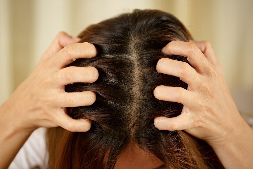 woman-has-problems-with-hair-scalp-she-has-dandruff-from-allergic-reactions-shampoos-hair-conditioner_109549-2508