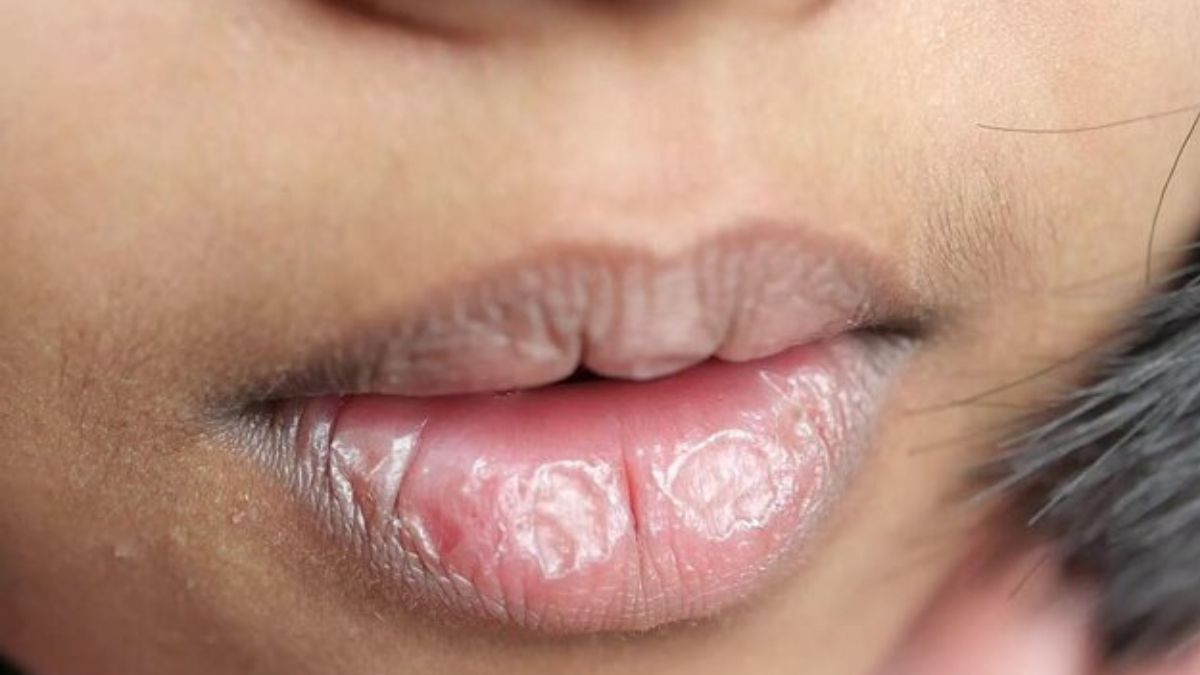 major-reasons-for-lip-pigmentation-1731974149592