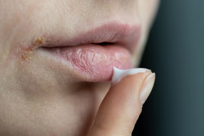 how-to-take-care-of-dry-and-cracked-lips-naturally