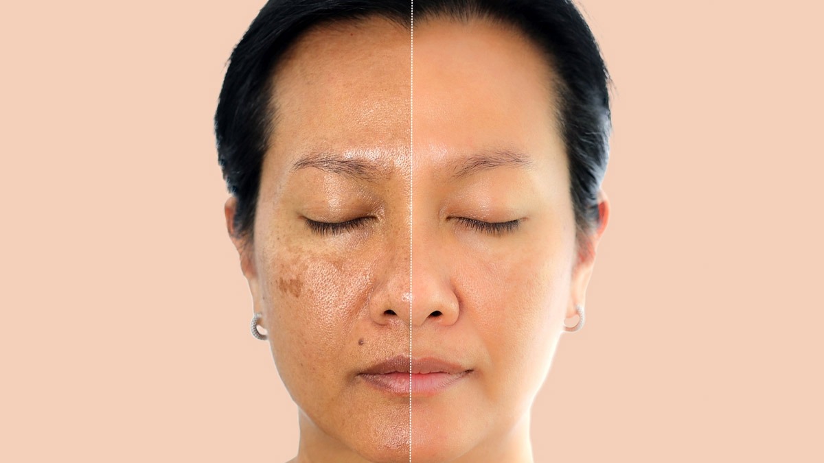 homemade mask to control acne marks and pigmentation