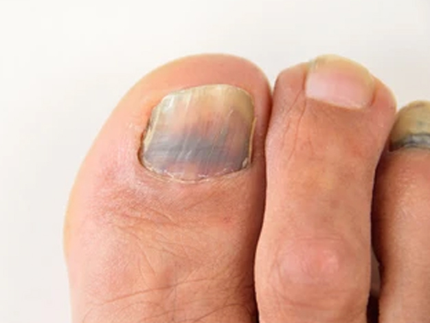 Why do nails change color during chemotherapy