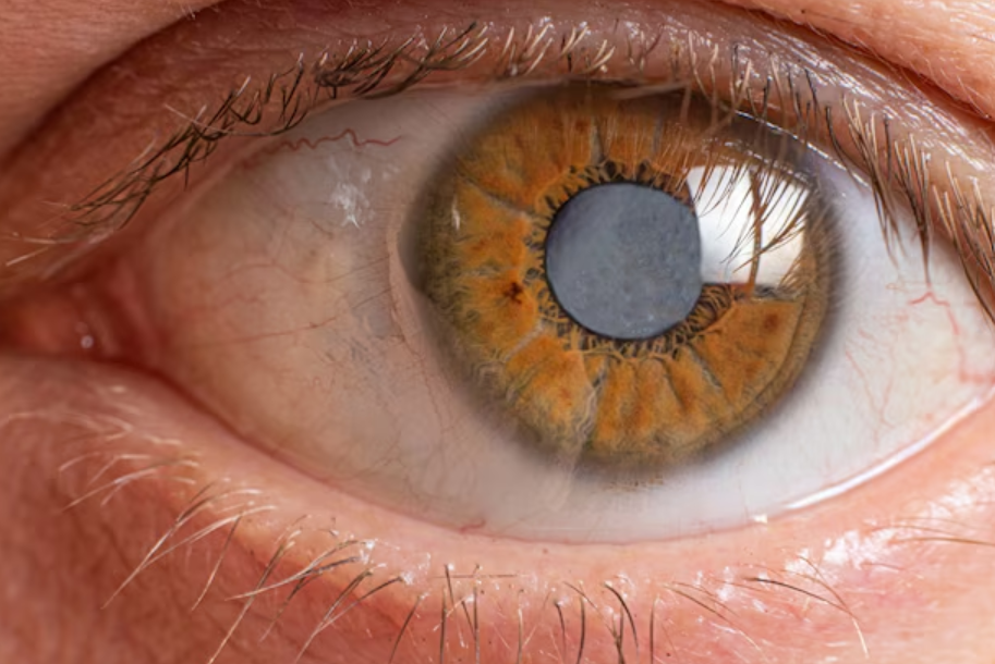 cataract due to sunlight