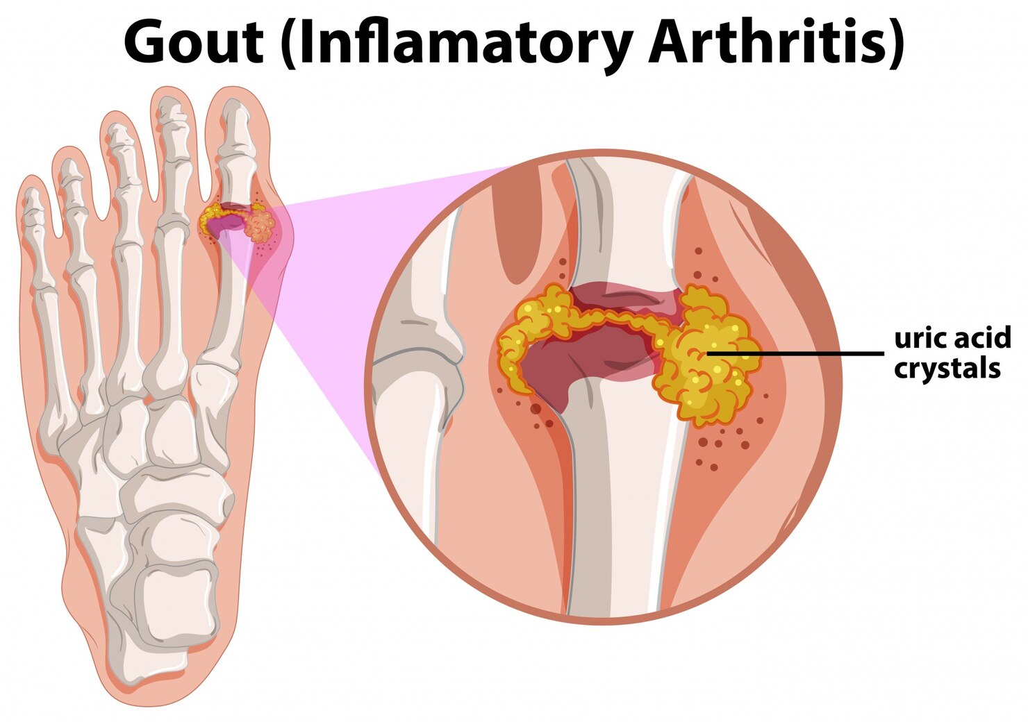 URIC ACID gout-human-foot