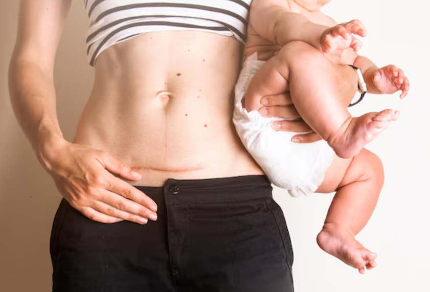 c section and lochia