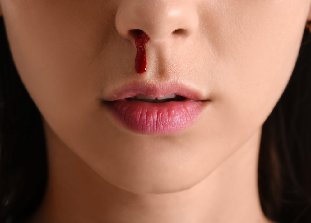 nose bleeding in summer garmiyo me naak se khoon behna causes precautions