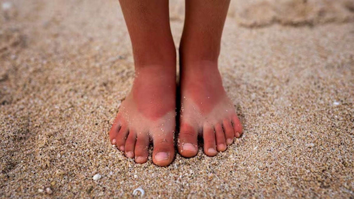 home remedies for tanning