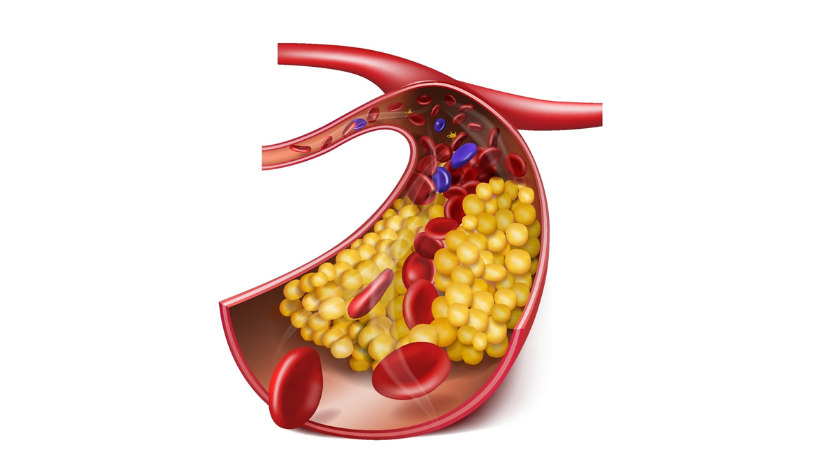 what causes bad cholesterol
