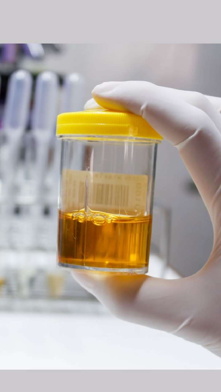 Is it normal to have air bubbles in urine