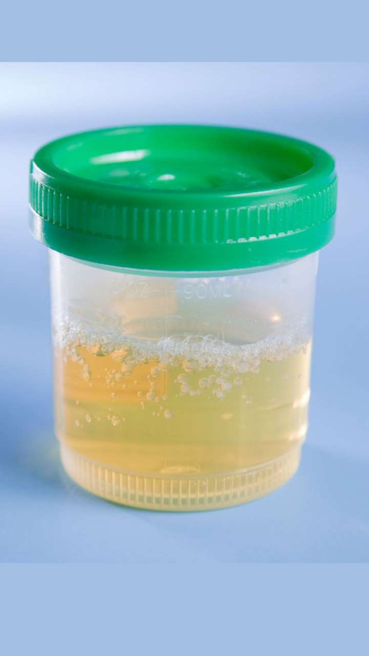 is it normal to have foamy urine or bubbles