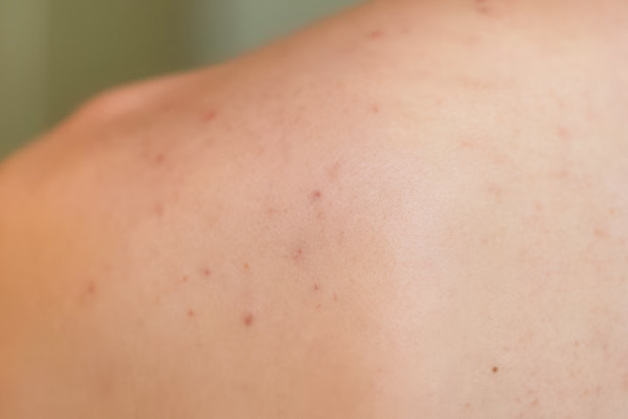 hands-patient-suffering-from-psoriasis