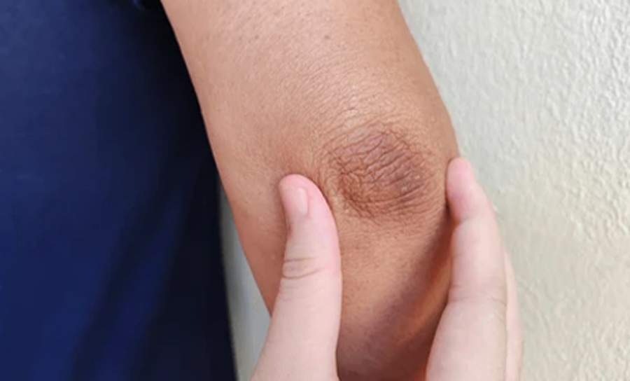 how to get rid off darkness of elbows