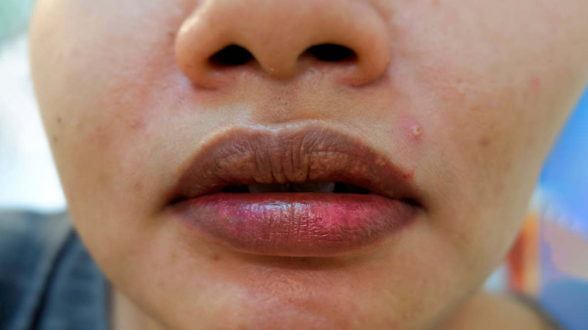 Dark-and-dull-lips-in-winter