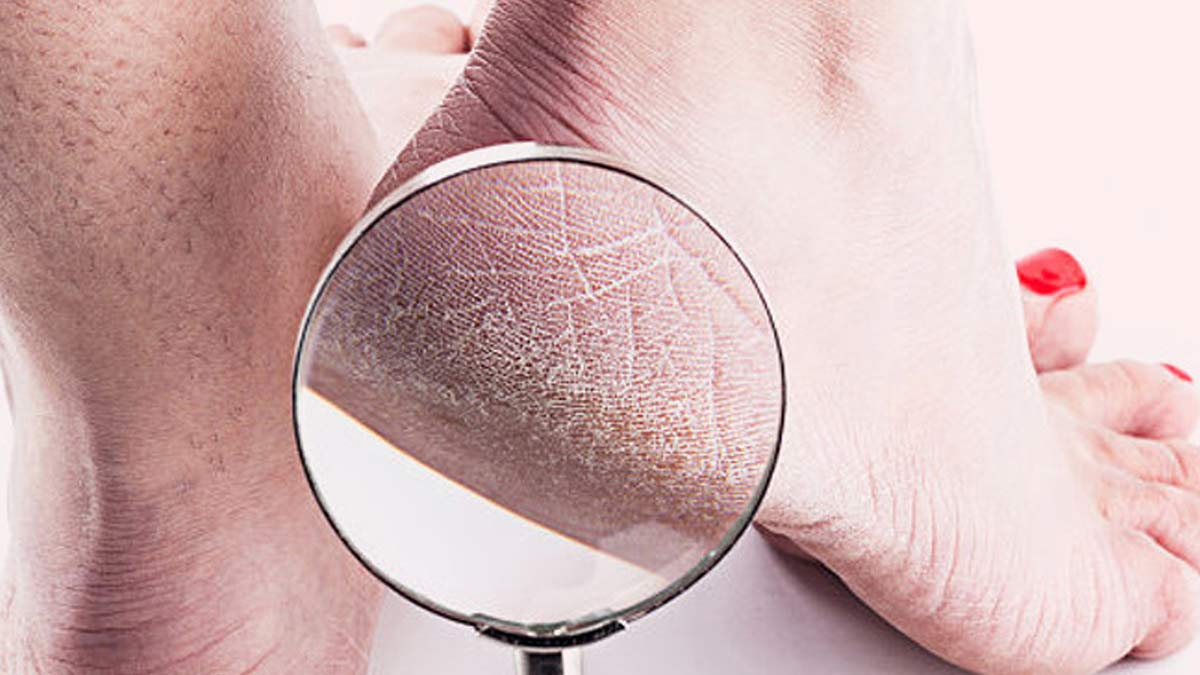 crack heels home remedies