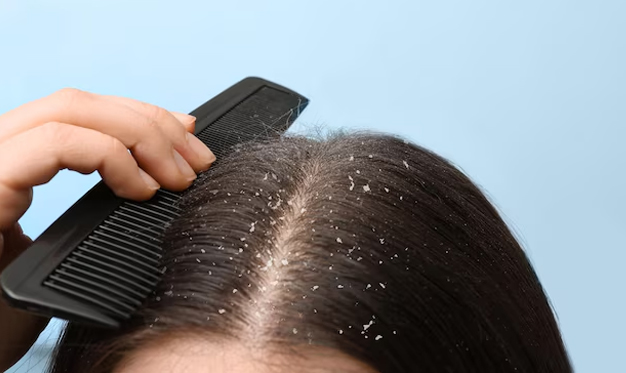 dandruff home remedies