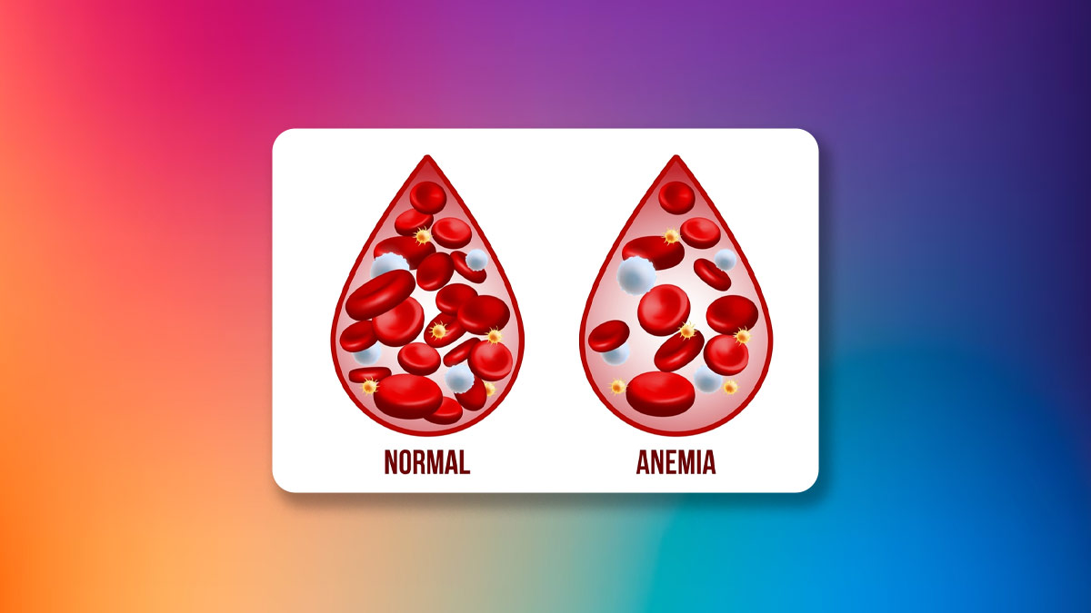 Iron deficiency symptoms
