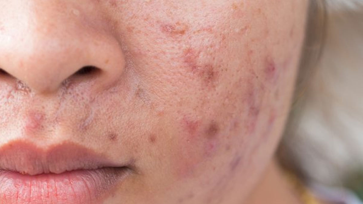 homemade drink for acne and dull skin