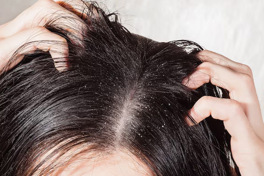 remedies to remove dandruff