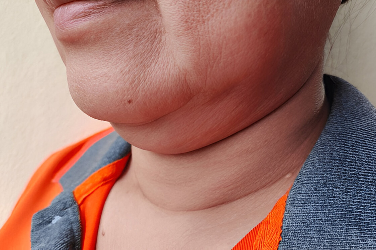 neck fat is a sign of sugar