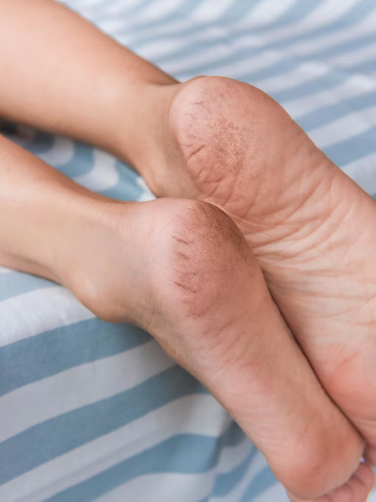 potato uses for cracked heels