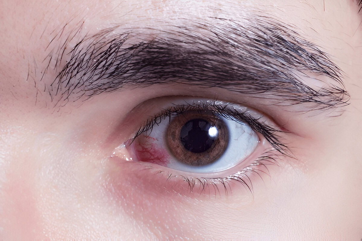 Prevent eye infections in monsoon