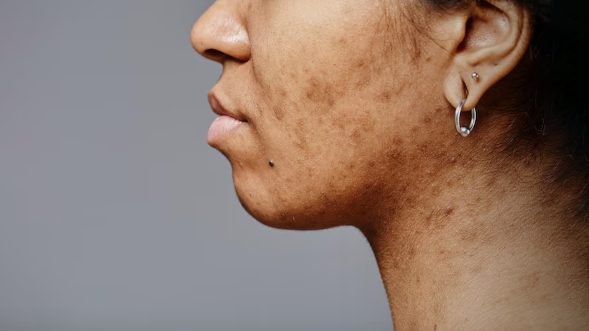 चेहरे के काले धब्बे अब और नहीं! आप भी झाइयों से हो गई हैं परेशान, तो घर पर  बनी इस क्रीम का करें इस्तेमाल | how to make skin pigmentation night cream