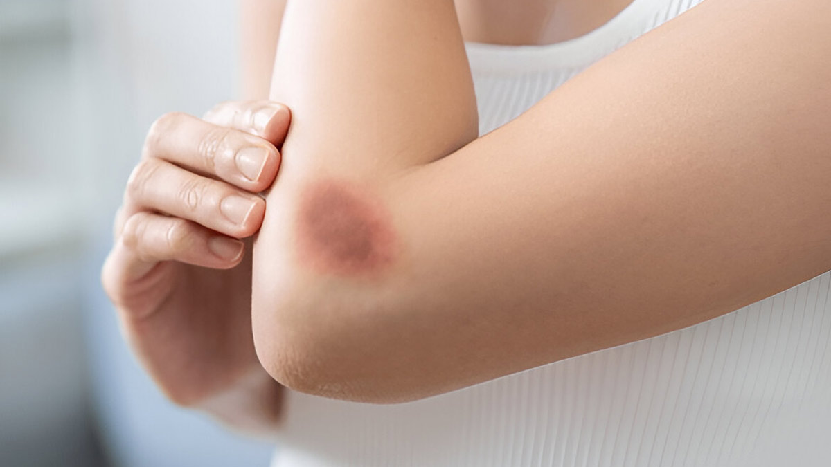what causes a female to bruise easily