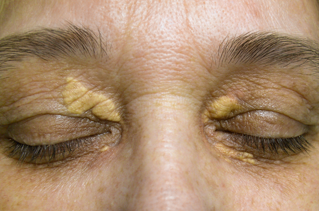 Xanthelasma Yellow Patches Around Eyes