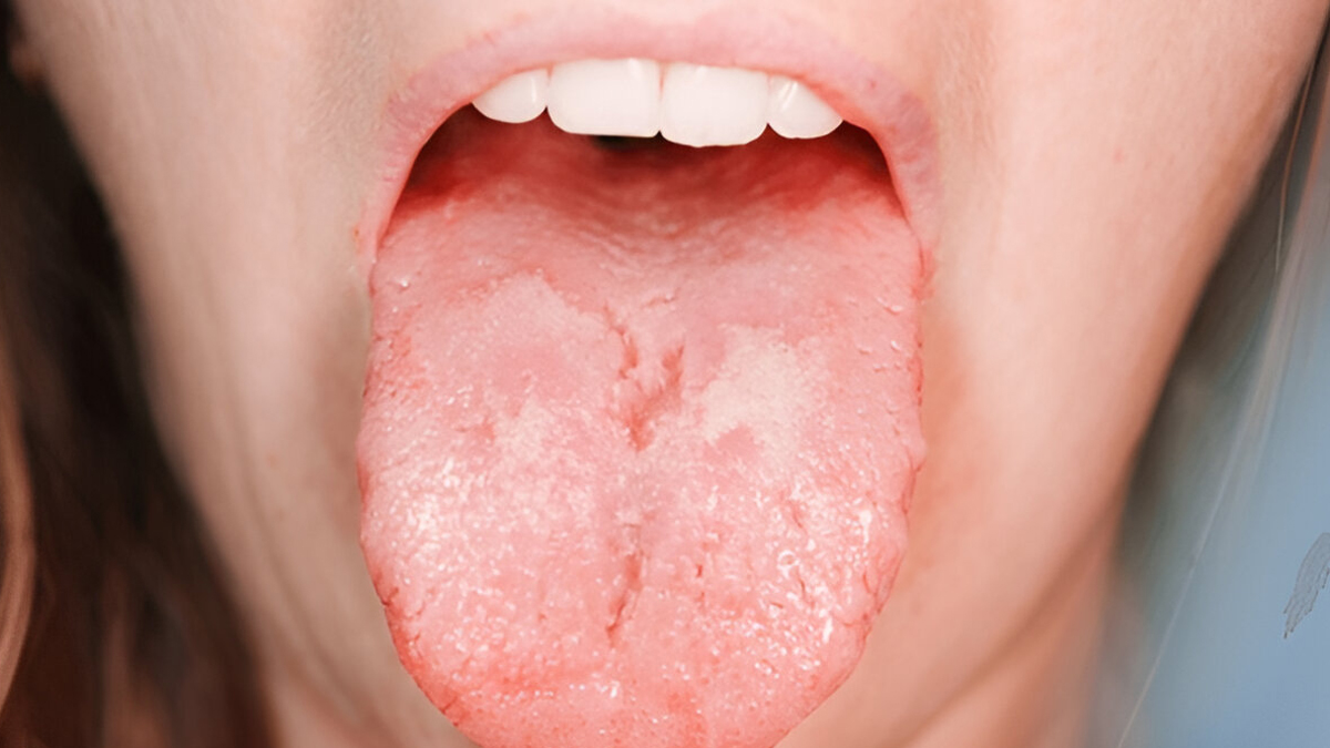 Common causes of a sore or white tongue