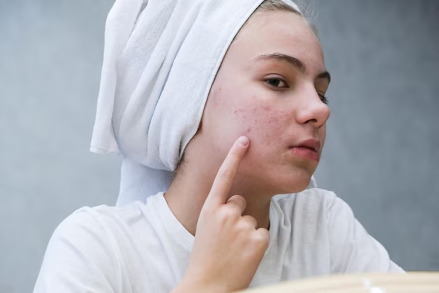 acne remove remedies