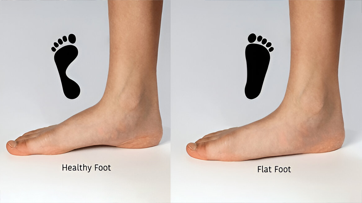 flat foot