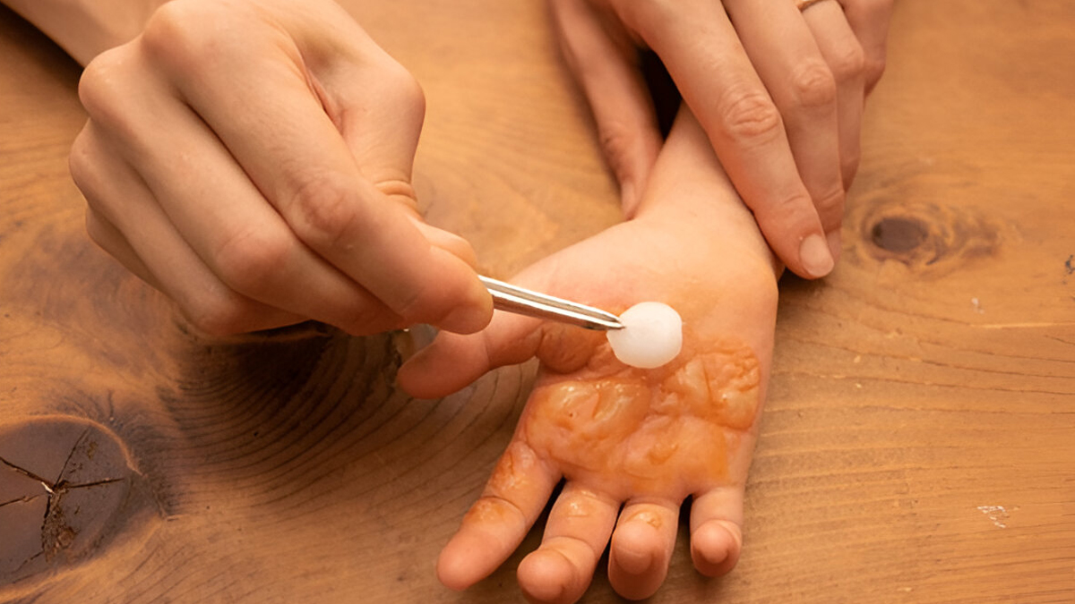 Treating a burn too quickly